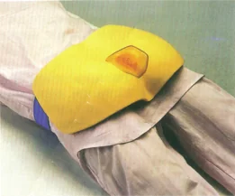 Mô hình: điều dưỡng loét do tì đè